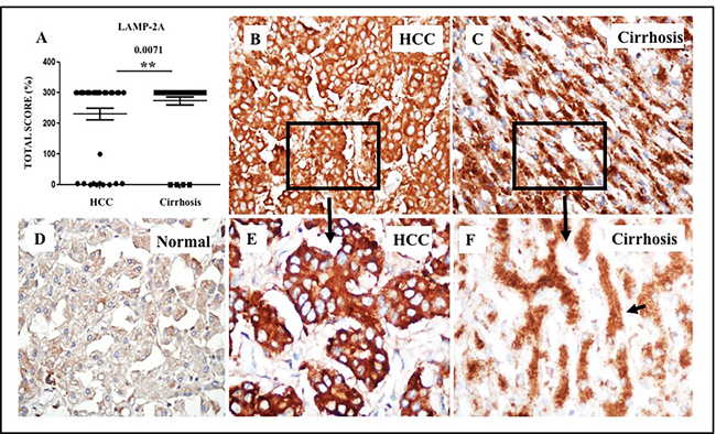 Expression of LAMP-2A protein in HCC and corresponding non-tumorous liver tissue.