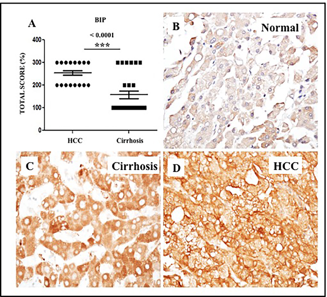 Expression of ER-stress chaperone (GRP78) proteins in HCC and adjacent non-tumorous cirrhotic liver.