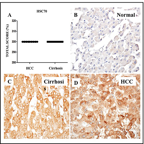 Expression of heat shock cognate protein (Hsc70) in HCC and adjacent non-tumorous cirrhotic liver.