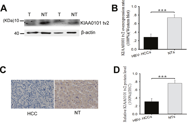 KIAA0101 tv2 is highly expressed in adjacent non-tumorous liver tissues (NTs) compared to hepatocellular carcinoma (HCC) tissues.