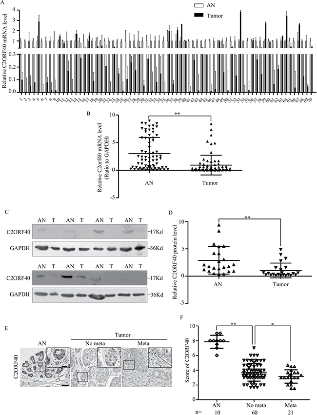 C2ORF40 expression deficiency correlates with breast cancer clinicopathologic characteristics.