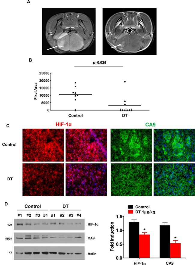 DT treated GSC have reduced capacity for tumor formation and attenuates HIF signaling in an orthotopic model.