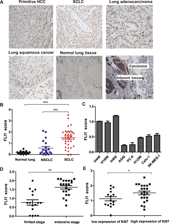 Aberrant expression of FLI1 in SCLC tissues.