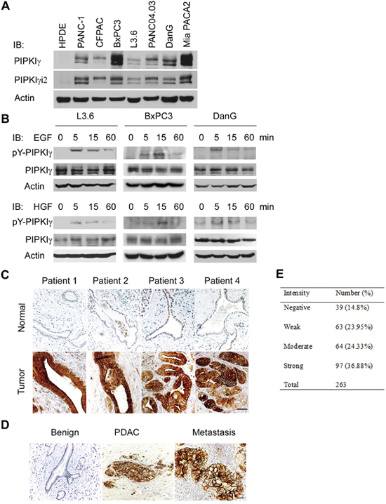 PIPKI&#x03B3; is upregulated in human pancreatic ductal carcinoma.