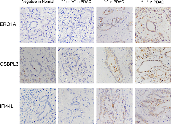 Characterization of ERO1A, OSBPL3 and IFI44L protein expression in human PDAC tissues and paired adjacent non-tumor tissues by immunohistochemistry staining and classified as strong expression (++), moderate expression (+), weak positive or negative expression (&pm; or -).