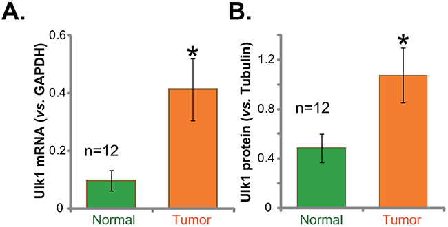 Ulk1 over-expression in fresh human gastric cancer tissues.