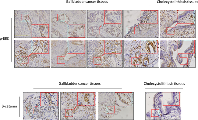 Activation of the MAPK/ERK and Wnt/&#x03B2;-catenin pathways in GBCs.