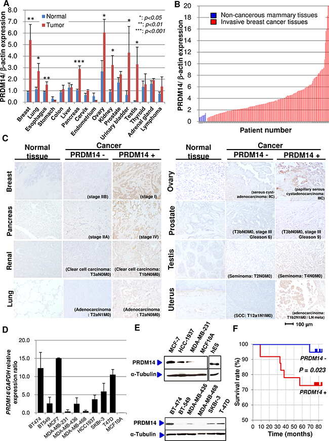 PRDM14 expression in cancer tissues.