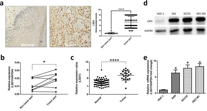 High expression of LSD1 existed in oral cancer.