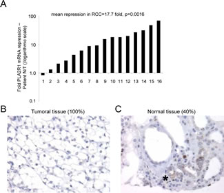 PLA2R1 expression decreases in clear cell renal cell carcinoma.