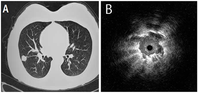 A 52-year-old male who underwent right middle lung lobectomy for pulmonary adenocarcinoma.