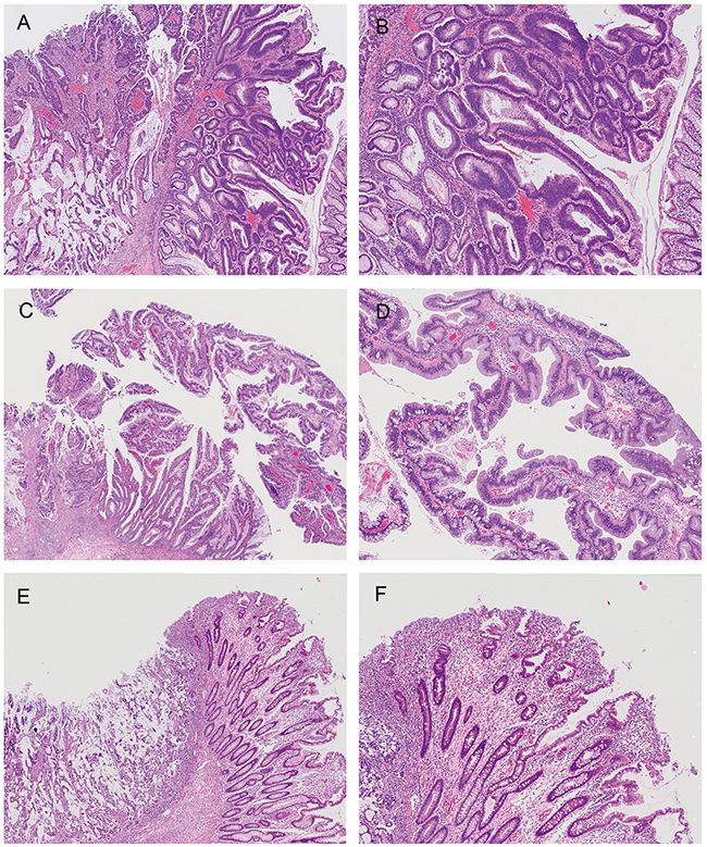 Lesions contiguous with the malignant tumor.