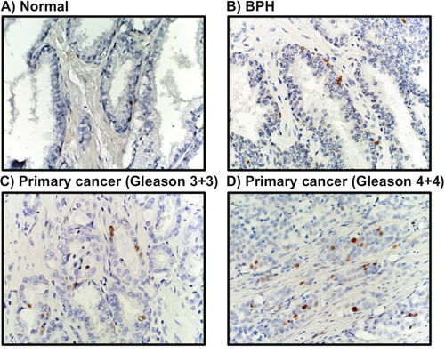 MCM3 expression in human prostate cancer.