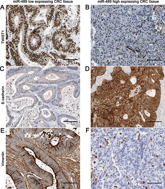Representative immunohistochemical staining of TWIST1, E-cadherin and Vimentin in CRC tissues.