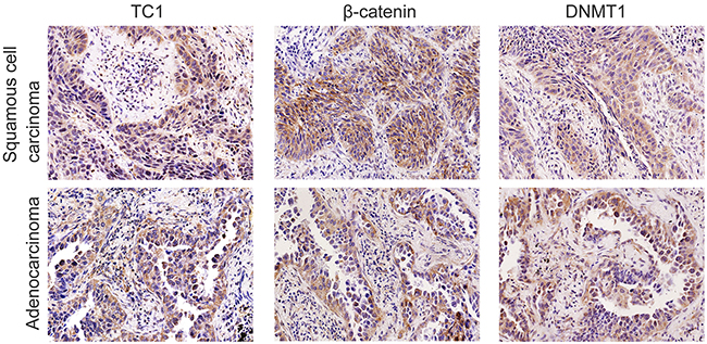 Expressions of TC1, &#x03B2;-catenin, and DNMT1 in representative lung cancer cases.