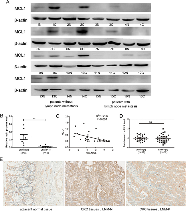 The protein expression level of MCL1 was downregulated in CRC tissue with lymph node metastasis compared to those without lymph node metastasis.