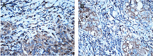 Different expression of CXCR1 in breast cancer tissues before and after neo-adjuvant chemotherapy (IHC,&#x00D7;400).