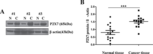Over-expression of P2X7R in oral cancer tissue.