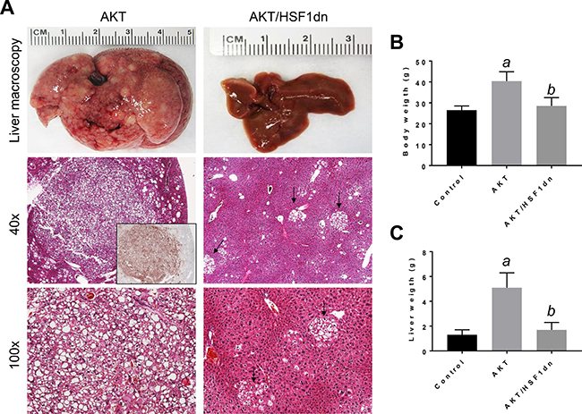 Inactivation of HSF1 abolishes AKT-driven hepatocarcinogenesis in mice.