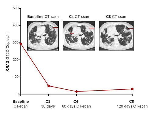 Pseudo-progression of lung metastases in patient # 2 after four courses of nivolumab, which was confirmed by favourable outcomes at the second evaluation.