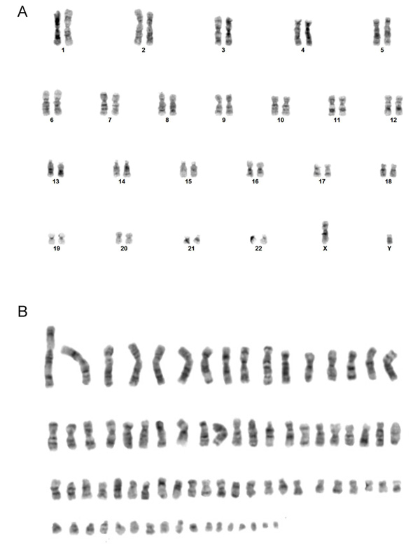 Representative karyotypes of a virally transformed lymphocyte from a normal individual (GM06865) (A), and of an osteosarcoma cell line (U2OS) with CIN (B).