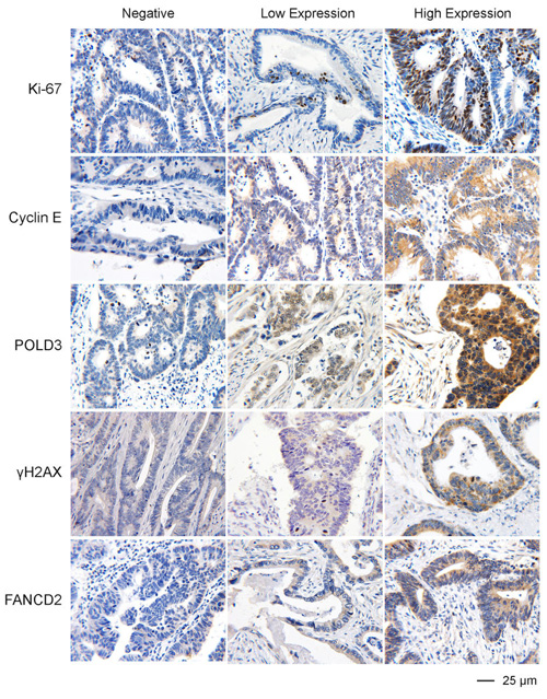 Representative IHC images of the expression of Ki-67, Cyclin E, POLD3, &#x3b3;H2AX, and FANCD2 in colon cancer FFPE specimens.