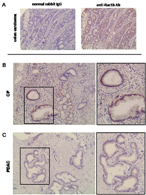 Immunohistochemical detection and quantification of Rac1b expression in CP and PDAC.