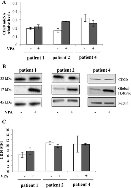 CD20 expression in patient cells is not affected by valproate despite induction of global H3K9 acetylation.