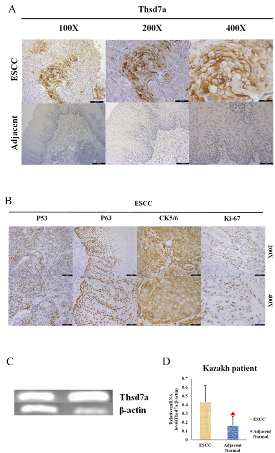 Immunohistochemical staining and RT-PCR for Thsd7a in ESCC and adjacent normal tissue of Kazakh patients.