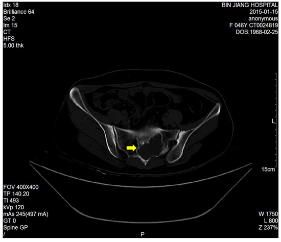 Axial CT scan showed a huge left sacral expansive lesions with marginal sclerosis(S1-2).
