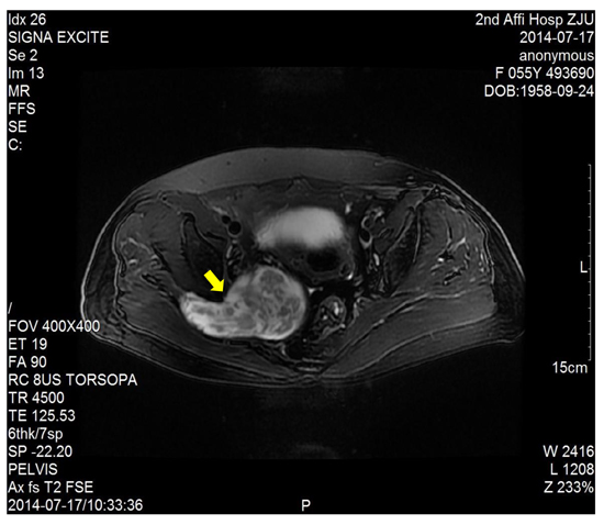 T2-weighted image showed a right sacral mass as a dumbbell-shaped configuration and mixed low signal intensity on the basis of high signal intensity.