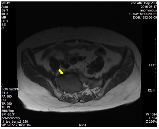 T1-weighted image showed a right sacral mass with low signal intensity.