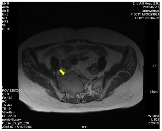 The enhanced T1-weighted image showed a right sacral mass with uneven enhancement.