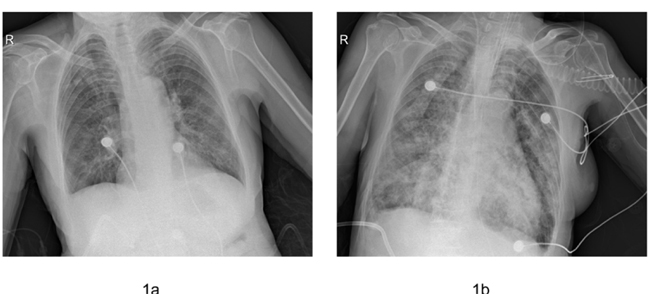 Comparison of the chest X-ray performed upon admission to the hospital (a) and upon intubation (b).