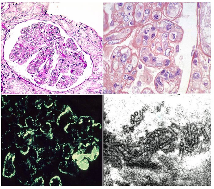 This picture shows the main features of cryoglobulinemic nephritis.