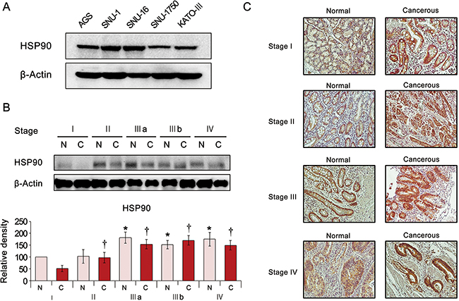 Expression of HSP90 in human gastric cancer cell lines and tissues.