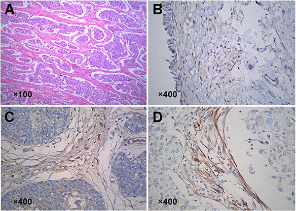 Expression of Kindlin-2 in bladder cancer and distant normal tissues.