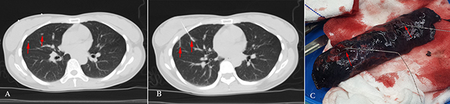 A 40-year-old female had two solid opacities with the diameter of 3 mm and 5 mm in the right middle lobe, respectively; the preoperative imaging diagnoses were considered to be indeterminate.