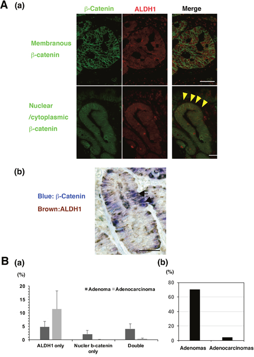 The co-expression of &#x03B2;-catenin and ALDH1 in non-ampullary adenomas and adenocarcinomas.