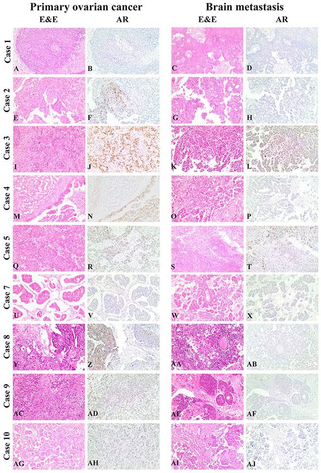 AR tumor expression in primary and metastatic lesions of our &#x201C;Case dataset&#x201D;.