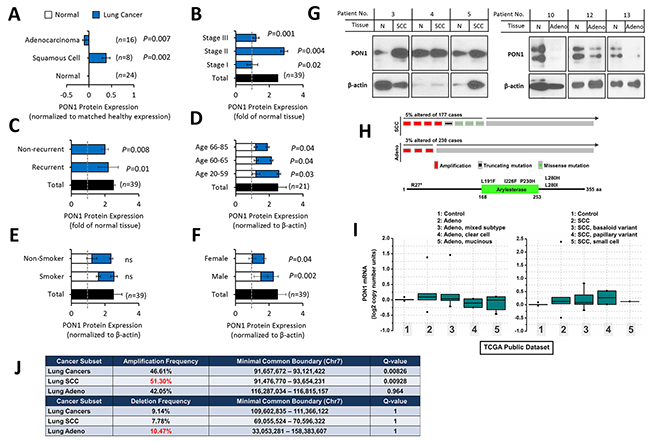 Variation of PON1 protein and gene expression between lung squamous cell carcinoma and lung adenocarcinoma patients.