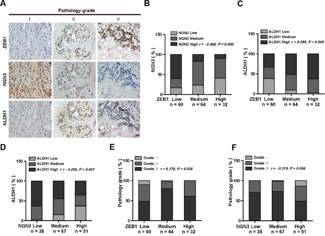 ZEB1 and NGN3 protein expression levels are inversely correlated in human breast cancer.