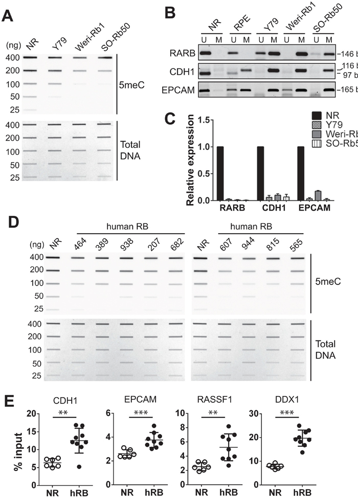 Differential methylation in retinoblastoma cells and primary tumors compared with normal retina.