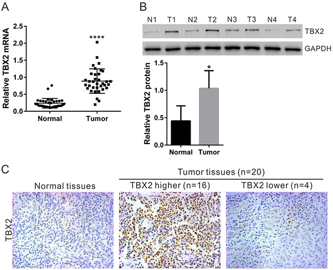 TBX2 expression in human NPC tissues.