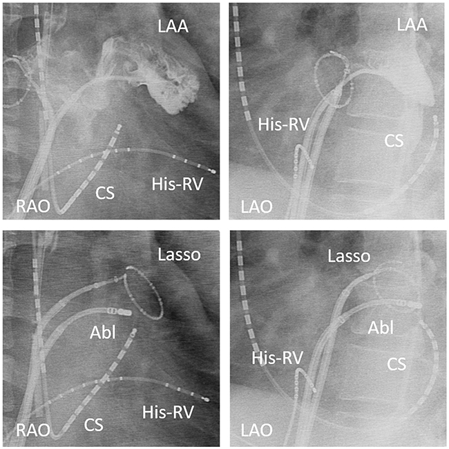 Angiography of the left atrial appendage (LAA) showing the boundary between the LAA and lateral free wall (upper panel).
