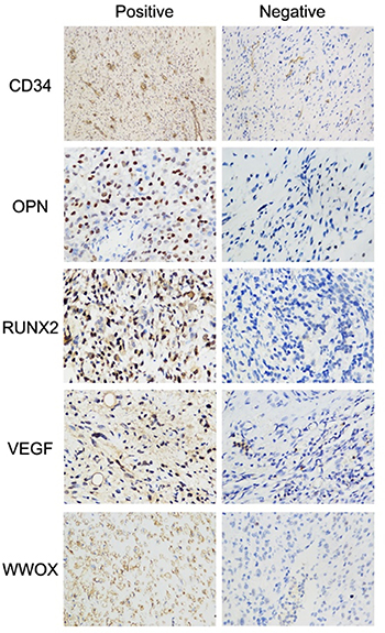 Representative immunohistochemical staining of WWOX, VEGF, RUNX2, OPN, and CD34 in osteosarcoma specimens.