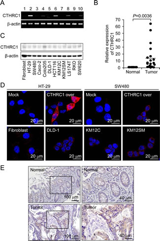 Upregulation of CTHRC1 mRNA expression in colon cancer.