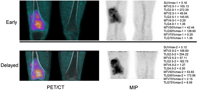 18F-FDG PET/CT imaging of a 47-year-old male who was diagnosed of osteosarcoma after surgery.