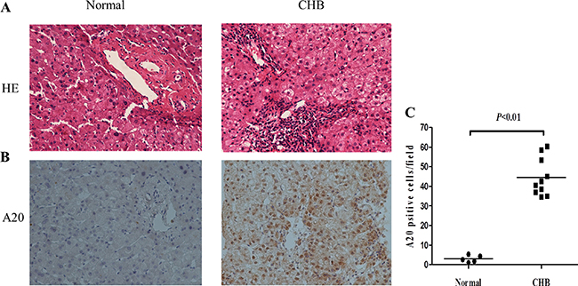 Increased expression of A20 in liver tissues from CHB patients.