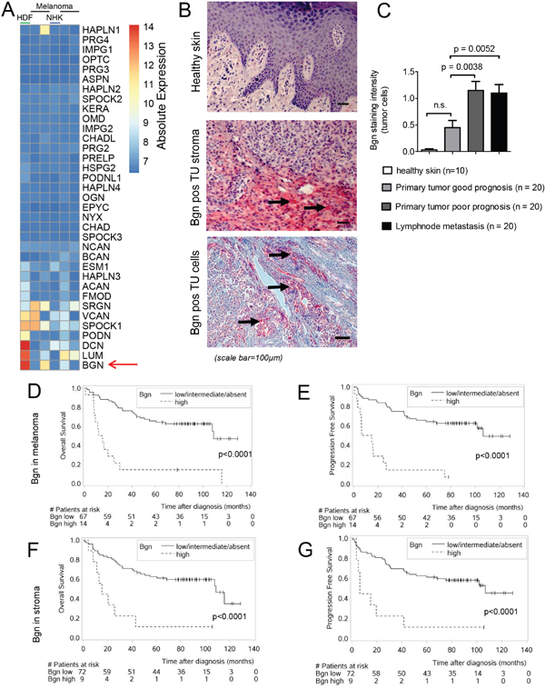 Bgn is highly expressed in melanoma cells and its expression in human melanoma tissue correlates with tumor invasiveness, overall survival and progression-free survival.